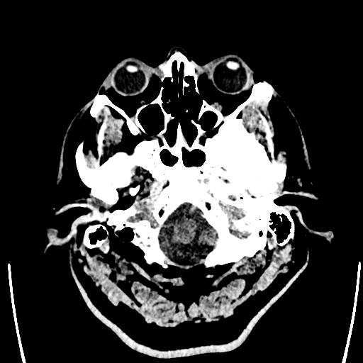 Acute left middle cerebral artery territory ischemic stroke (Radiopaedia 35688-37223 Axial non-contrast 5).png