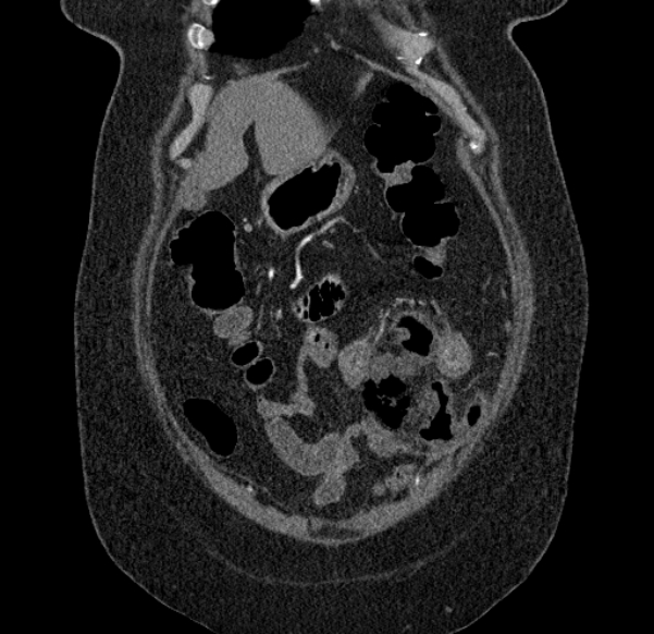 Acute mesenteric ischemia (Radiopaedia 80029-93316 Coronal C+ arterial phase 21).jpg