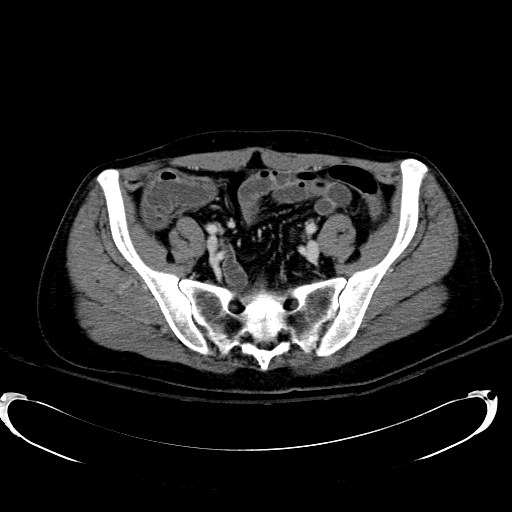 Acute myocardial infarction in CT (Radiopaedia 39947-42415 Axial C+ portal venous phase 100).jpg