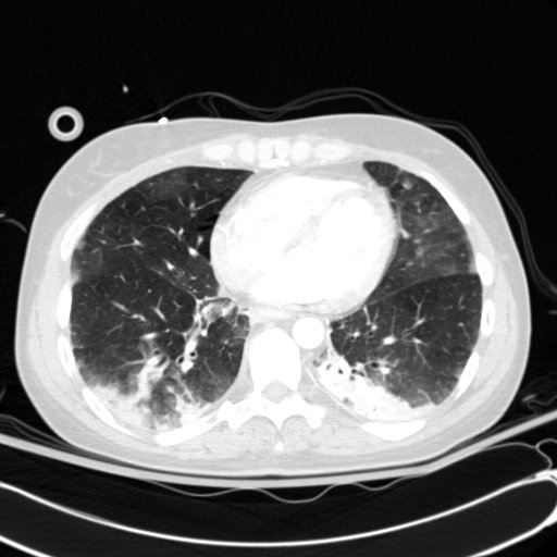 Acute myocardial infarction in CT (Radiopaedia 39947-42415 Axial lung window 88).jpg