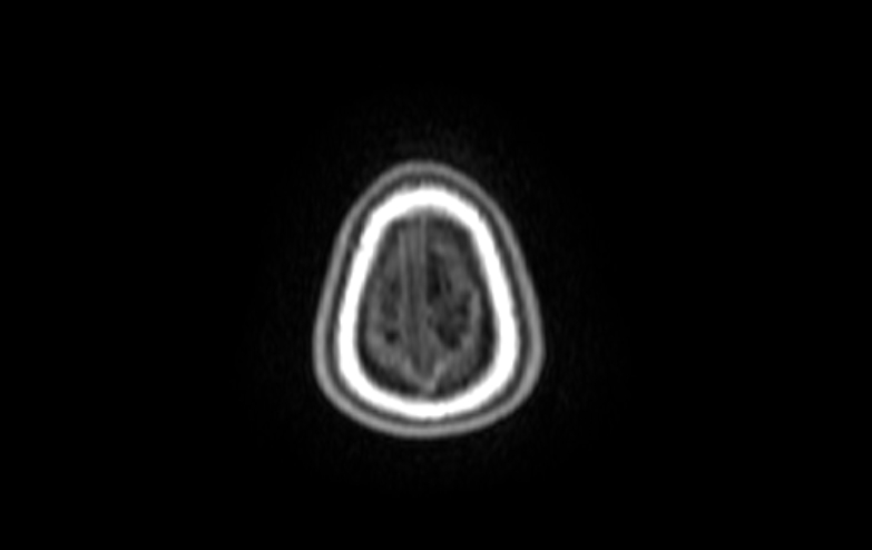 File:Acute necrotizing encephalitis of childhood (Radiopaedia 67356-76737 Axial T1 3).jpg