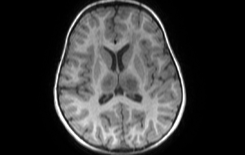 Acute necrotizing encephalitis of childhood (Radiopaedia 67356-76737 Axial T1 40).jpg