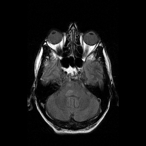 File:Acute necrotizing toxoplasma encephalitis (Radiopaedia 10683-11149 Axial FLAIR 14).jpg