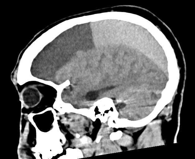 Acute on chronic subdural hematoma (Radiopaedia 78346-90966 Sagittal non-contrast 41).jpg