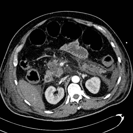 File:Acute pancreatic necrosis (Radiopaedia 13560-13486 Axial C+ portal venous phase 58).jpg