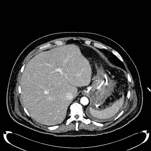 Acute pancreatic necrosis (Radiopaedia 13560-18500 Axial C+ portal venous phase 32).jpg