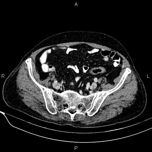 Acute pancreatitis (Radiopaedia 85146-100701 Axial C+ portal venous phase 51).jpg