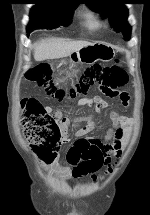 Acute pancreatitis and walled-off necrosis (Radiopaedia 29888-30403 E 15).jpg