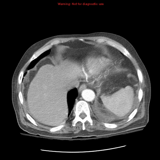 File:Acute pancreatitis with incidental pancreatic lipoma (Radiopaedia 10190-10730 Axial C+ arterial phase 15).jpg