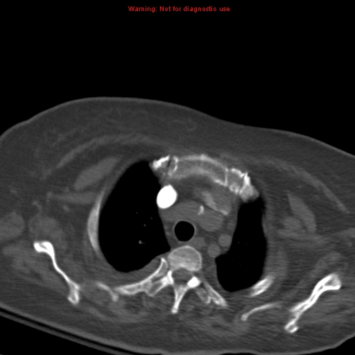 File:Acute pulmonary embolism (Radiopaedia 13286-13289 Axial C+ CTPA 14).jpg