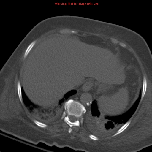 Acute pulmonary embolism (Radiopaedia 13286-13289 Axial C+ CTPA 58).jpg