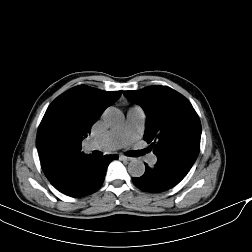 File:Acute pulmonary embolism (Radiopaedia 69510-79390 Axial non-contrast 7).jpg