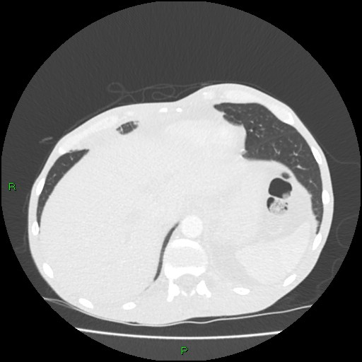 Acute right lung abscess (Radiopaedia 34806-36258 Axial lung window 164).jpg