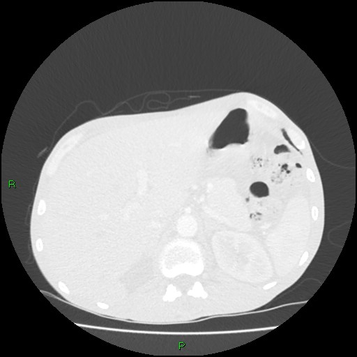 Acute right lung abscess (Radiopaedia 34806-36258 Axial lung window 187).jpg