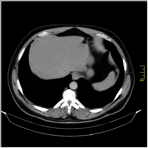 Acute right sided diverticulitis (Radiopaedia 65249-74268 Axial C+ portal venous phase 8).JPG