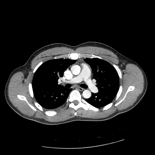 File:Acute segmental pulmonary emboli and pulmonary infarction (Radiopaedia 62264-70444 Axial C+ CTPA 49).jpg