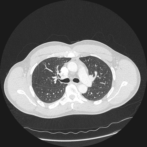 Acute segmental pulmonary emboli and pulmonary infarction (Radiopaedia 62264-70444 Axial lung window 67).jpg