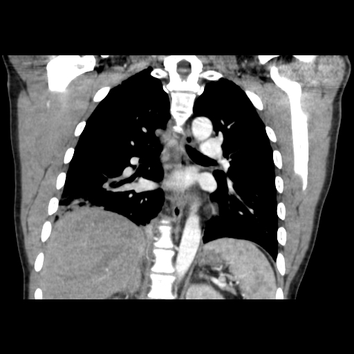 Acute segmental pulmonary emboli and pulmonary infarction (Radiopaedia 62264-70444 Coronal C+ CTPA 33).jpg