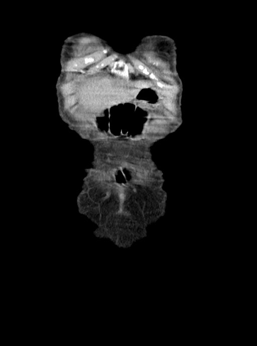 Acute small bowel (ileal) volvulus (Radiopaedia 71740-82139 Coronal C+ portal venous phase 9).jpg