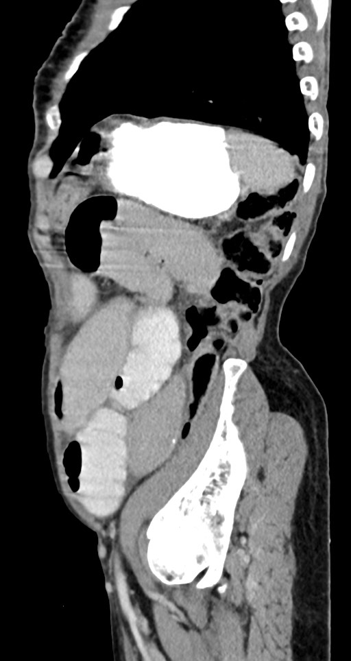 Acute small bowel (ileal) volvulus (Radiopaedia 71740-82139 Sagittal C+ portal venous phase 47).jpg
