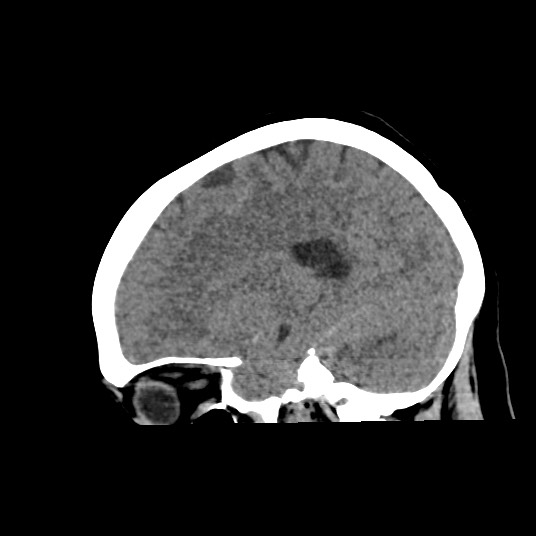 Acute subarachnoid hemorrhage and accessory anterior cerebral artery (Radiopaedia 69231-79008 Sagittal non-contrast 23).jpg