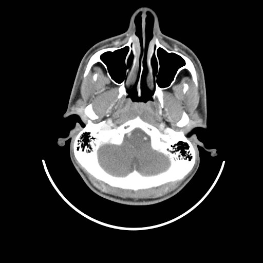 File:Acute submandibular sialadenitis secondary to ductal stone (Radiopaedia 27999-28267 Axial C+ delayed 8).jpg