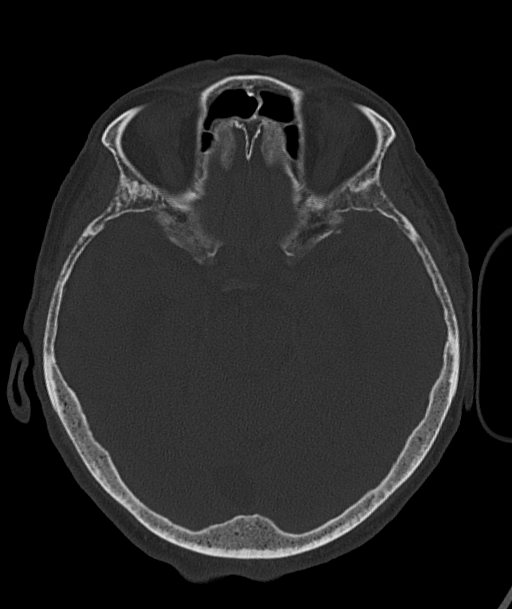 Acute traumatic subdural hematoma (Radiopaedia 82921-97257 Axial bone window 68).jpg
