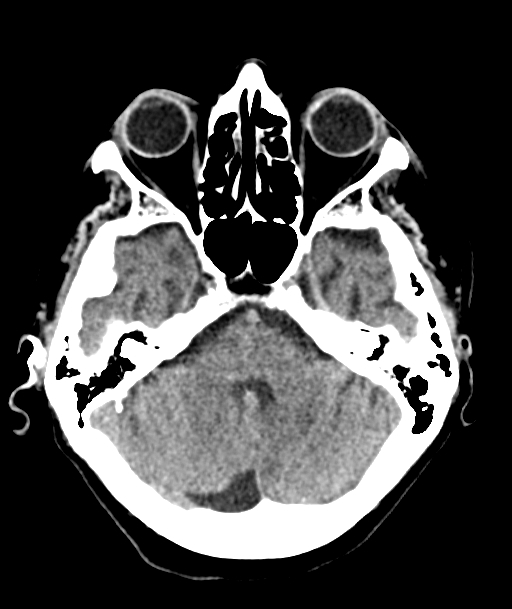 Acute traumatic subdural hematoma (Radiopaedia 82921-97257 Axial non-contrast 47).jpg