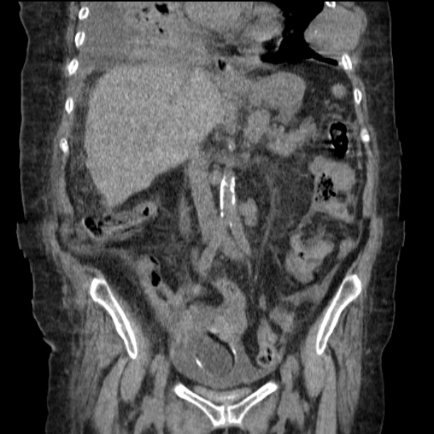 Acute tubular necrosis (Radiopaedia 28077-28334 D 44).jpg