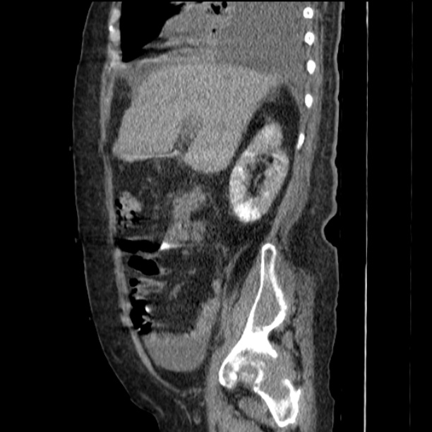 Acute tubular necrosis (Radiopaedia 28077-28334 Sagittal non-contrast 31).jpg
