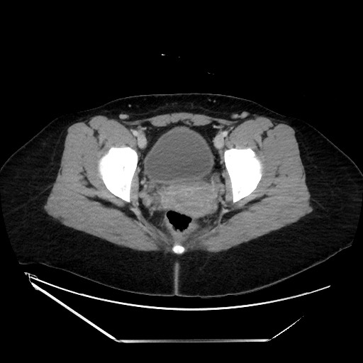Acute uncomplicated appendicitis (Radiopaedia 73704-84499 Axial C+ portal venous phase 150).jpg