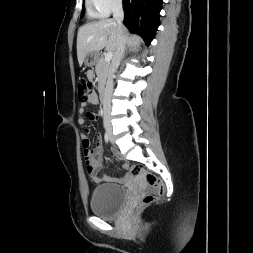 Acute uncomplicated appendicitis (Radiopaedia 73704-84499 Sagittal C+ portal venous phase 105).jpg