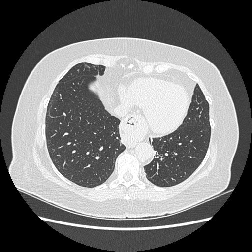 Adenocarcinoma in situ of lung (Radiopaedia 38685-40829 B 194).png