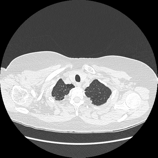 Adenocarcinoma in situ of lung (Radiopaedia 38685-40829 B 23).png