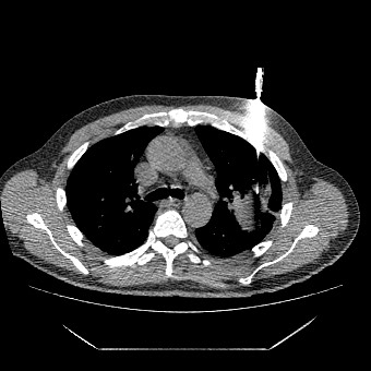 File:Adenocarcinoma of the lung (Radiopaedia 59871-67327 Axial non-contrast 1).jpg