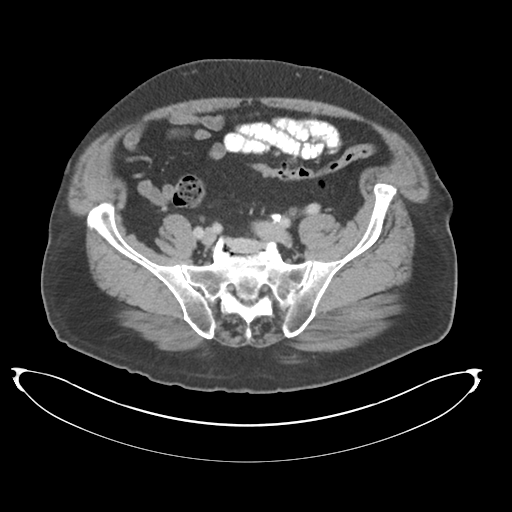 Adenocarcioma of rectum- T1 lesion (Radiopaedia 36921-38547 Axial C+ portal venous phase 66).png