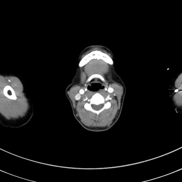 Adenocystic carcinoma of the trachea (Radiopaedia 47677-52525 Axial C+ arterial phase 17).jpg