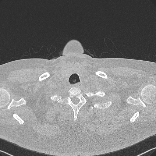 Adenoid cystic carcinoma of the trachea (Radiopaedia 49042-54137 Axial lung window 11).jpg