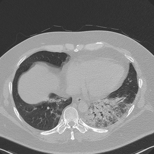 Adenoid cystic carcinoma of the trachea (Radiopaedia 49042-54137 Axial lung window 254).jpg