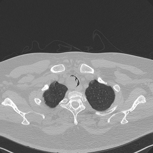 Adenoid cystic carcinoma of the trachea (Radiopaedia 49042-54137 Axial lung window 37).jpg