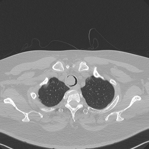Adenoid cystic carcinoma of the trachea (Radiopaedia 49042-54137 Axial lung window 44).jpg