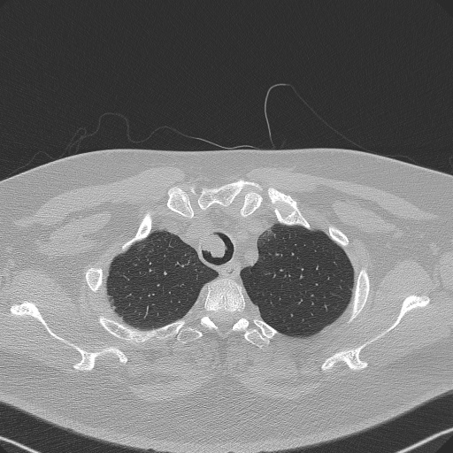 Adenoid cystic carcinoma of the trachea (Radiopaedia 49042-54137 Axial lung window 52).jpg