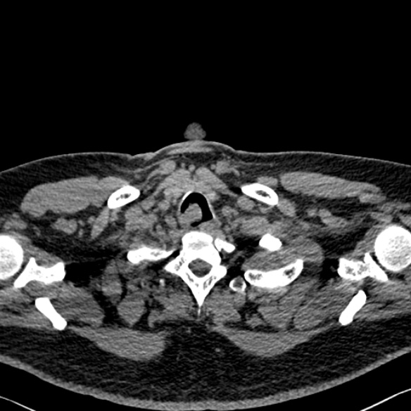 Adenoid cystic carcinoma of the trachea (Radiopaedia 49042-54137 Axial non-contrast 16).jpg