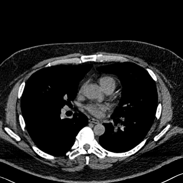 Adenoid cystic carcinoma of the trachea (Radiopaedia 49042-54137 Axial non-contrast 184).jpg