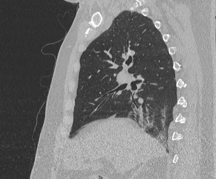 Adenoid cystic carcinoma of the trachea (Radiopaedia 49042-54137 Sagittal lung window 182).jpg
