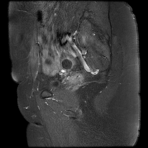 File:Adenomyosis-scar endometriosis (Radiopaedia 65863-75022 Sagittal T1 C+ fat sat 6).jpg
