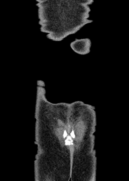 Adhesional small bowel obstruction (Radiopaedia 48397-53305 Coronal C+ portal venous phase 349).jpg