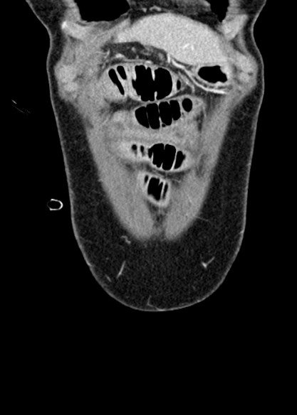 Adhesional small bowel obstruction (Radiopaedia 48397-53305 Coronal C+ portal venous phase 45).jpg