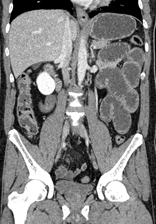 Adhesional small bowel obstruction (Radiopaedia 58900-66131 Coronal C+ portal venous phase 148).jpg