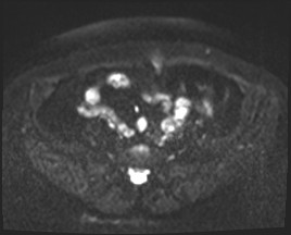 File:Adnexal multilocular cyst (O-RADS US 3- O-RADS MRI 3) (Radiopaedia 87426-103754 Axial DWI 2).jpg